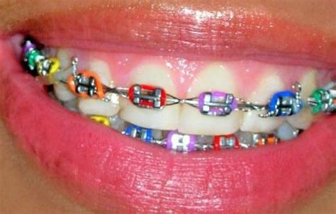 Types Of Braces For Teeth | Types Of