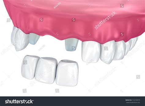 Tooth Supported Fixed Bridge Medically Accurate Stock Illustration ...