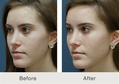 Tear Trough Filler By Courtney Carolina Facial Plastics