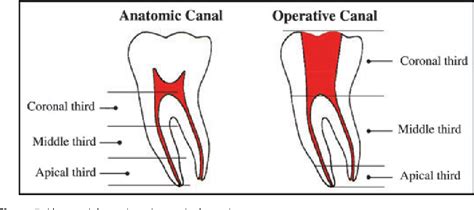 Figure 5 From Anatomic Endodontic Technology Aet A Crown Down Root