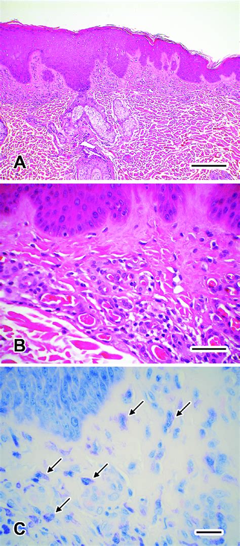 Biopsy Of The Skin Lesion From The Sparsely Haired Skin Of The Ventral