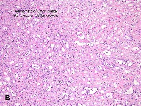 American Urological Association Adenomatoid Tumor