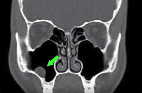 How To Read A Ct Sinus Scan For The Layperson Fauquier Ent Blog