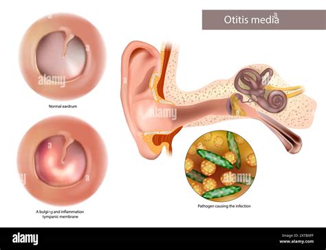 Otitis Media or Chronic Suppurative. Pathogen causing the infection. Normal eardrum and bulging ...