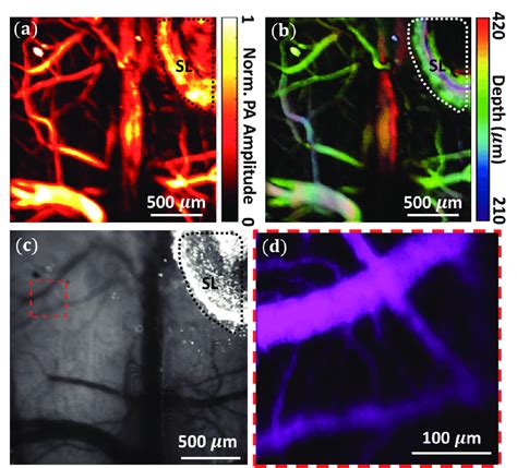 A Reconstructed Maximum Intensity Projection Mip Of The