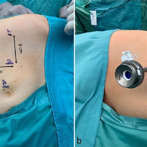 A Trocars Position In The Right Lateral Transabdominal Hugo