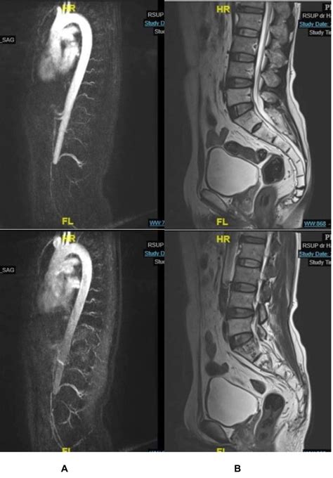 Magnetic resonance imaging (MRI). (A) Magnetic resonance angiography ...