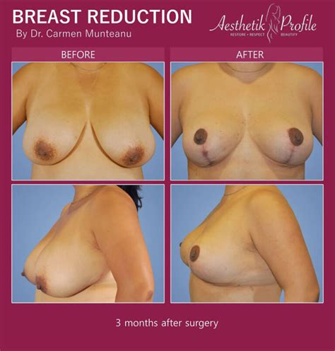 Breast Reduction Before After Photos Dr Carmen Munteanu