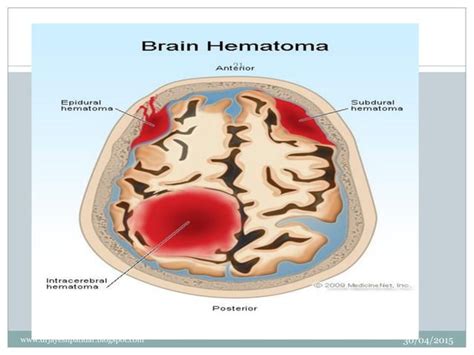 Head injury | PPT | Free Download