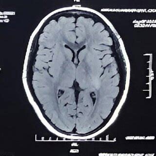 Hyperintense T2/FLAIR Axial images on left insular lobe and adjacent ...