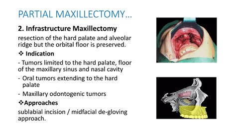 1 MAXILLECTOMY Pptx