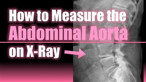 How To Measure The Abdominal Aorta On X Ray Howto Medical Doctor