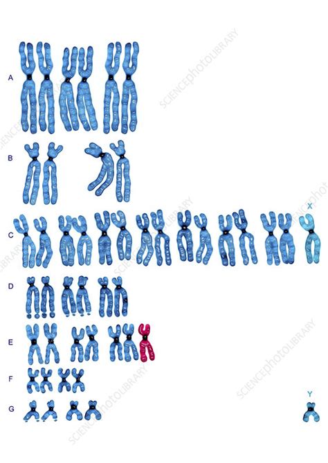 Trisomy 18 - Stock Image - C004/0338 - Science Photo Library