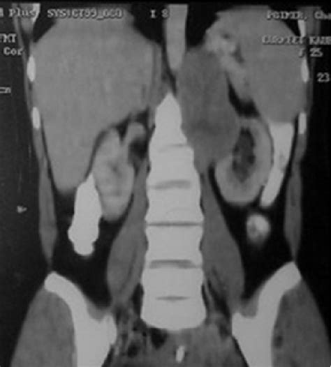 Figure 1 From Renal Preservation In A Giant Retroperitoneal Schwannoma