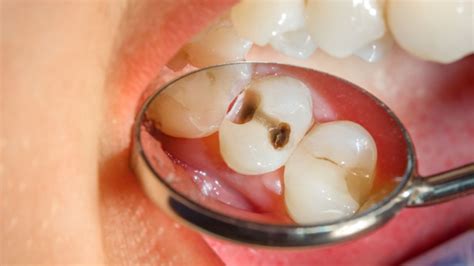 Black Stains On Teeth Causes And Treatment In Bassendean