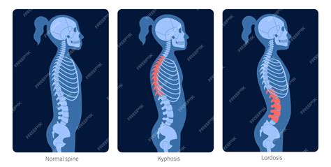 Premium Vector Normal Spine Lordosis And Kyphosis Scoliosis In