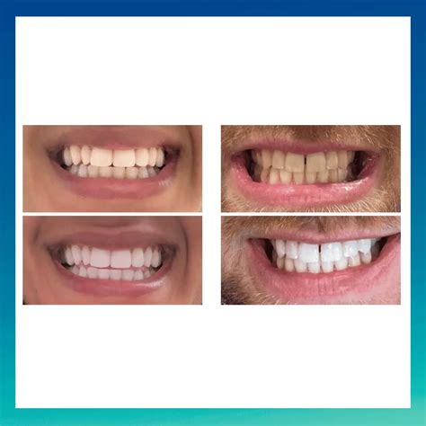 Teeth Whitening Before and After: Results, Photos, and Best Methods