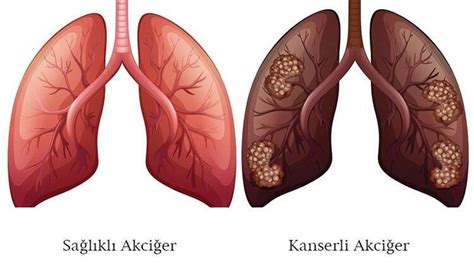Akci Er Kanseri Evreleri Ya Am S Resi Ve Tedavisi