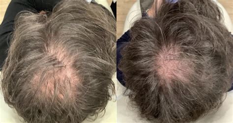 Hair Restoration Before After Photos Patient Washington Dc Mi