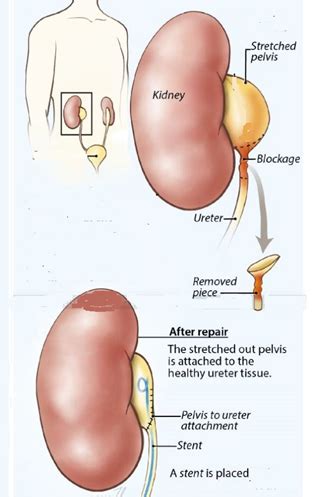 Robotic Pyeloplasty - Chin Chong Min Urology & Robotic Surgery Centre