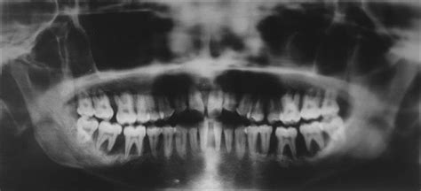 Preoperative Orthopantomogram Revealing Extensive Bone Loss In The