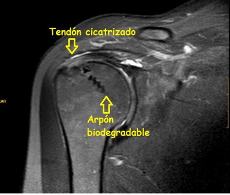 Patolog As De Hombro Ruptura De Tendon Supraespinoso