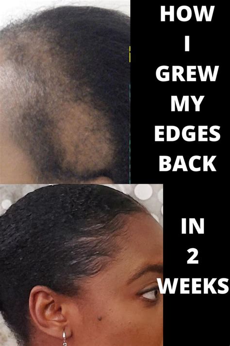 How To Grow Your Edges Back In Weeks Thinning Edges Edges Hair