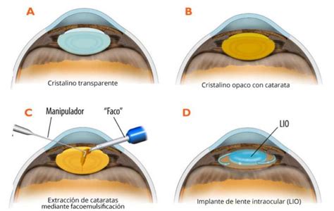 Las Cataratas Y Su Tratamiento