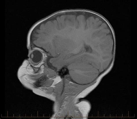 Sonographic Detection Of Unilateral Retinoblastoma Shiloh Sutton