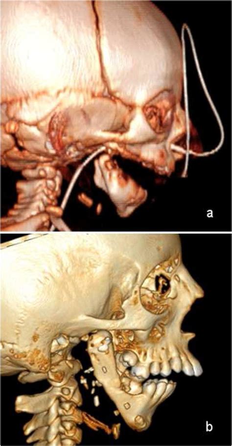 Ct Scan Before First Mandibular Distraction A And After 2 Years From