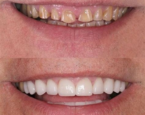 Full Mouth Reconstruction Reclaim Your Beautiful Smile