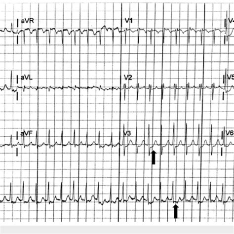 Initial Electrocardiogram Demonstrating Supraventricular Tachycardia Download Scientific