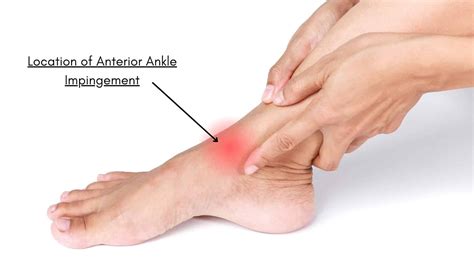 Anterior Ankle Impingement Symptoms Causes And Treatment