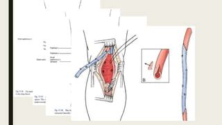 Popliteal artery aneurysm | PPT