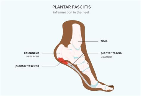 Podiatrists For Plantar Fasciitis In Bridlewood Calgary