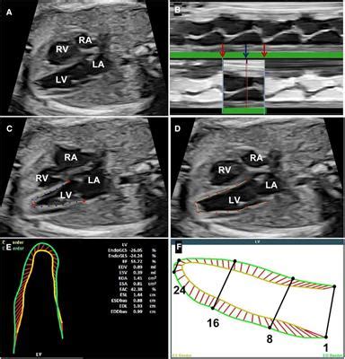 Frontiers Characteristics And Outcomes Of Fetal Ventricular Aneurysm