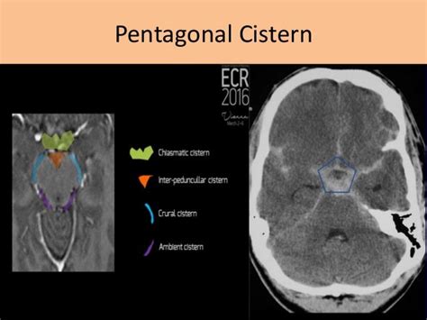 Cisterns Of Brain And Its Contents Along With Its Classification And