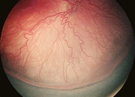 Retinopathy Of Prematurity Treatment Retinal Consultants Medical Group