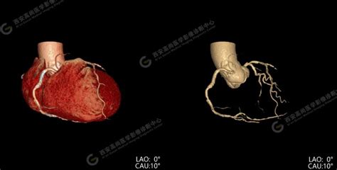 高尚医学影像之冠状动脉 Ct 血流储备分数 Ai 定量分析（ct Ffr） 医院汇 丁香园