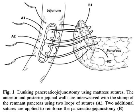 Which Is The Best Technique Tx For A Pancreatico Enteric