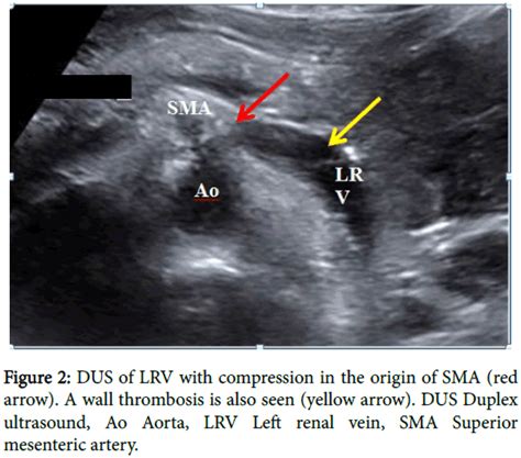 Nutcracker Syndrome Vascular Imaging With Ultrasound A Case Report