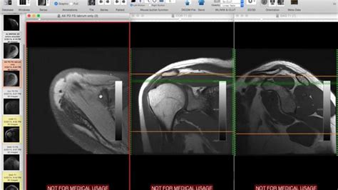 Systematic Interpretation Of Shoulder Mri How I Do It Youtube