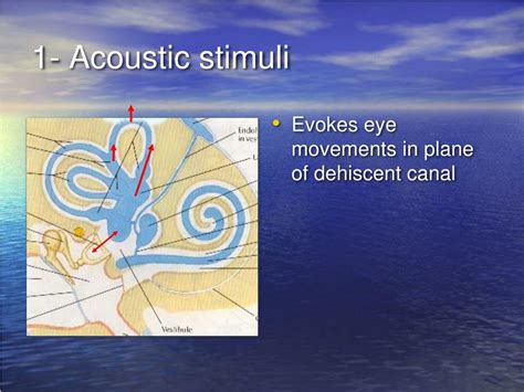 Ppt Superior Semicircular Canal Dehiscence Syndrome Powerpoint