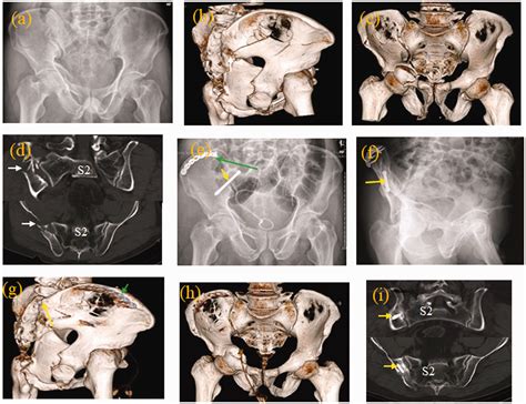 Cannulated Iliac Screw Fixation Combined With Reconstruction Plate