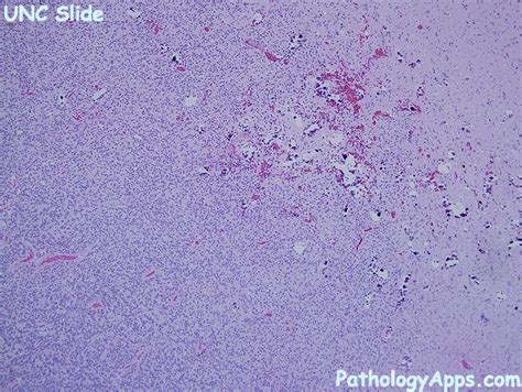 oligodendroglioma pathology