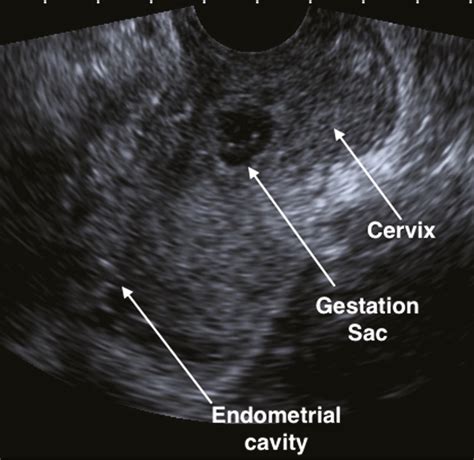 Ectopic Pregnancy Ultrasound 8 Weeks