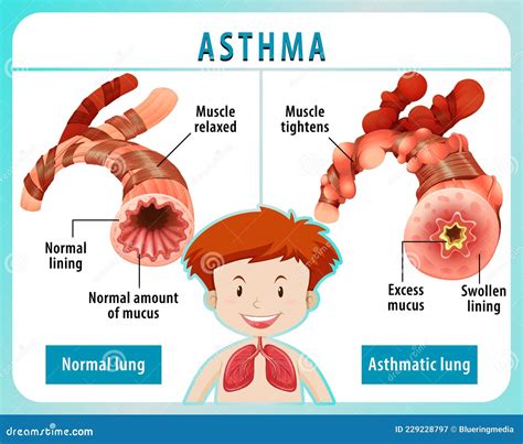 Asthma Diagram With Normal Airway And Asthmatic Airway Vector ...