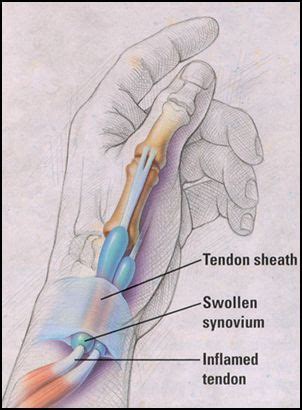 DeQuervains Tendonitis | Physica