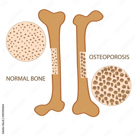 osteoporosis bone anatomy  normal health bone vector format