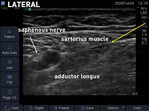 How I Do It Saphenous Nerve Block